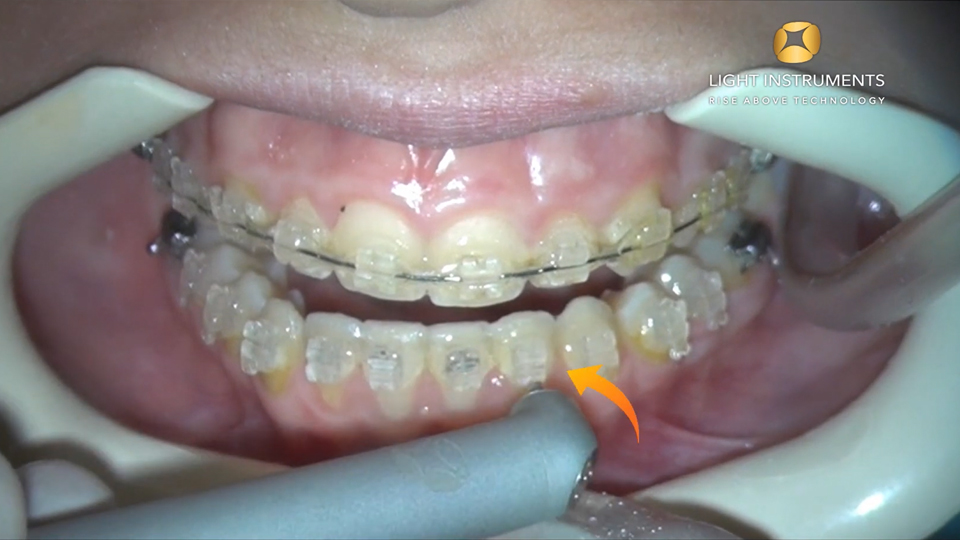 <strong>Bracket removal with LiteTouch™ Er:YAG laser</strong>