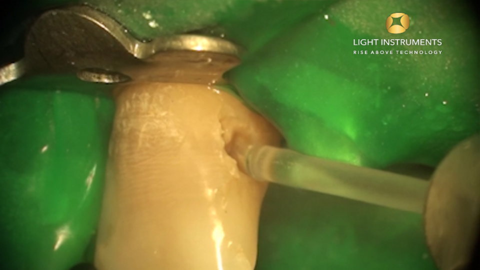 <strong>Caries removal II with LiteTouch™ Er:YAG laser</strong>