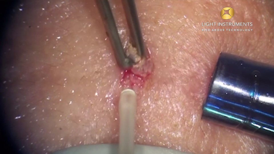 <strong> Fibroma removal with LiteTouch™ Er:YAG laser </strong>