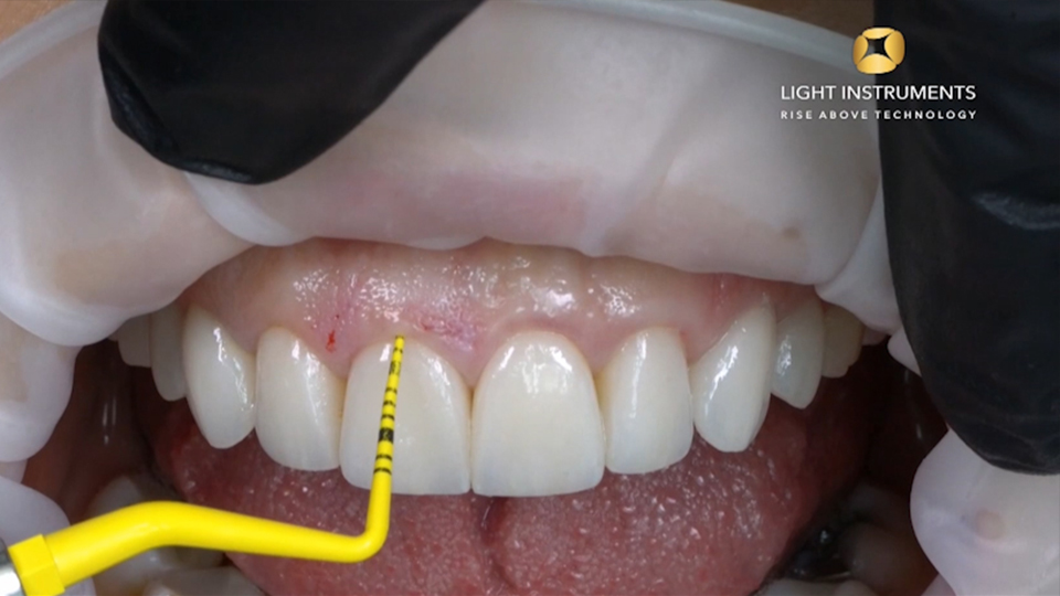 <strong>Gingival contouring surgery with LiteTouch™ Er:YAG laser</strong>