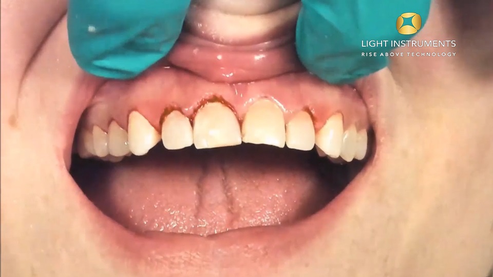 <strong>Gingivectomy for crown lengthening with LiteTouch™ Er:YAG laser</strong>