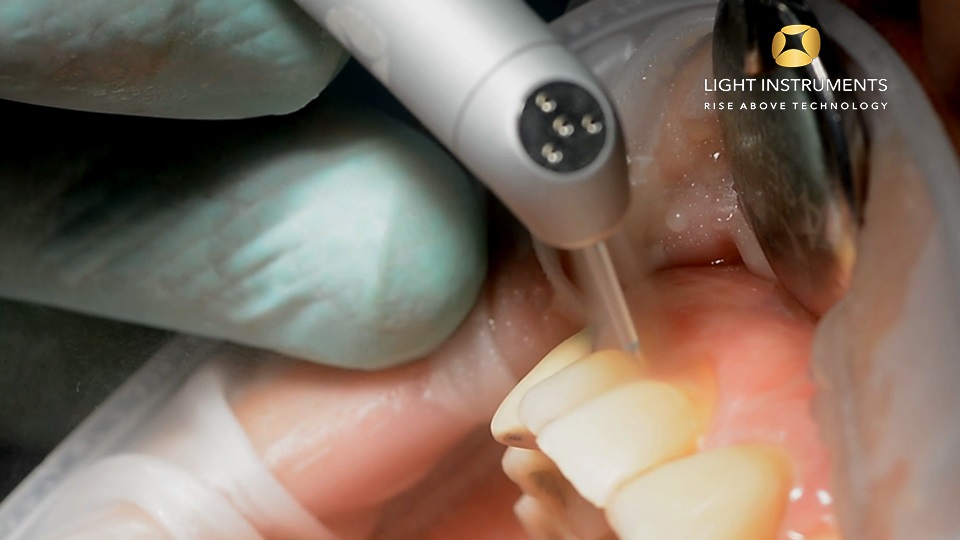 Restorative Dentistry With The Litetouch™ Eryag Light Instruments Ltd