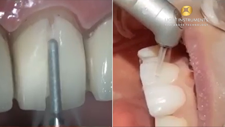 <strong>Veneer removal comparison between turbine and LiteTouch™ Er:YAG laser</strong>