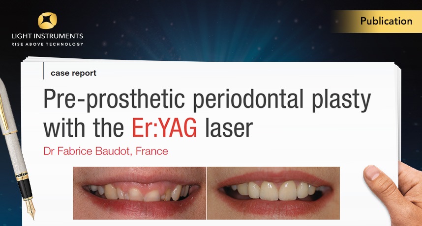 Pre-prosthetic periodontal plasty with the Er:YAG laser