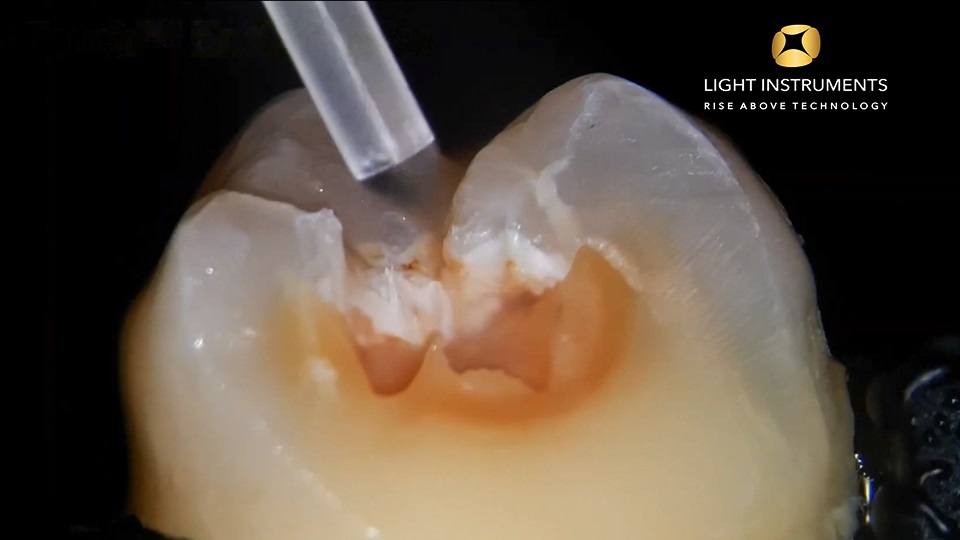 <strong>Laser preparation of carious dentin with LiteTouch™ Er:YAG laser</strong>