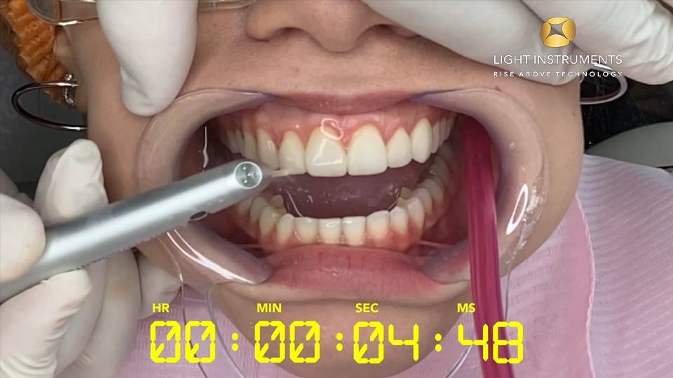 <strong>Veneer removal with LiteTouch™ Er:YAG laser (countdown)</strong>