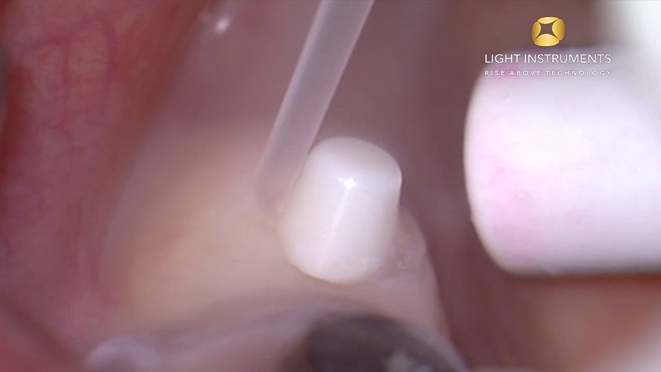<strong> Gingiva recontouring around zirconia implant with LiteTouch™ Er:YAG laser</strong>