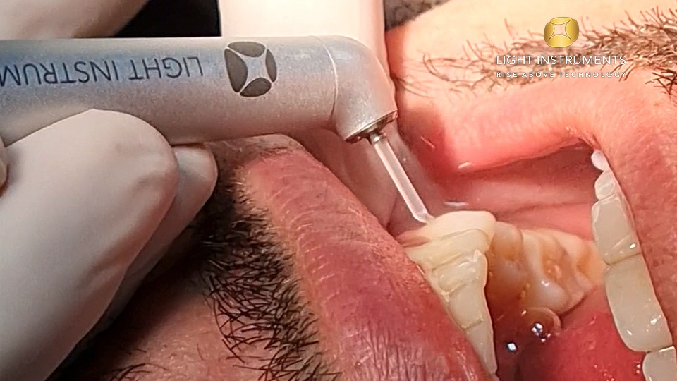 <strong>Desensitizing of root necks with LiteTouch™ Er:YAG laser</strong>
