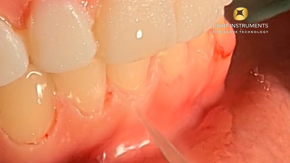 <strong>Gingivectomy with LiteTouch™ Er:YAG laser </strong>