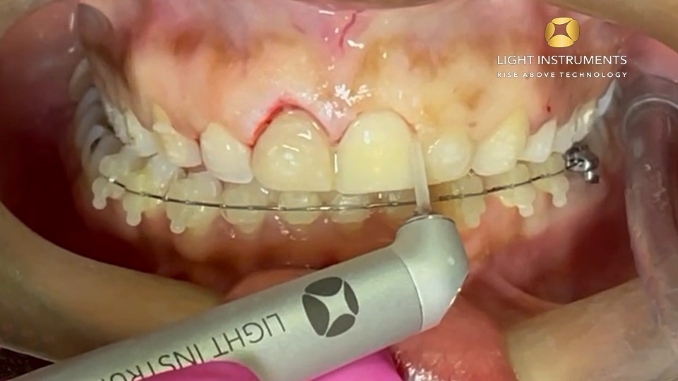 <strong>Gingivectomy - design technique with LiteTouch™ Er:YAG laser</strong>