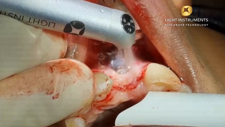 <strong> Removal of Implant with LiteTouch™ Er:YAG laser</strong>