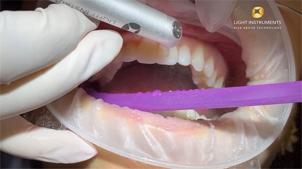 <strong>Veneer removal with LiteTouch™ Er:YAG laser</strong>