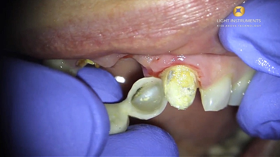 <strong>Zirconia bridge removal with LiteTouch™ Er:YAG laser </strong>
