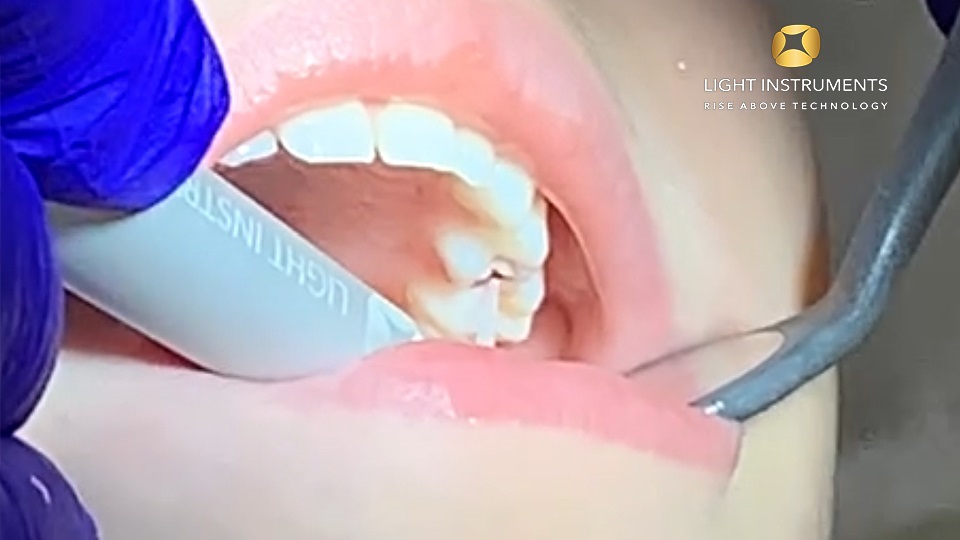 <strong>Caries removal in deciduous teeth with LiteTouch™ Er:YAG laser</strong>