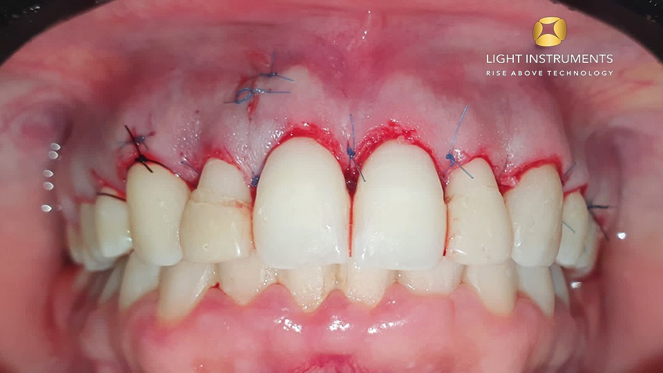 <strong>Crown lengthening with LiteTouch™ Er:YAG laser</strong>