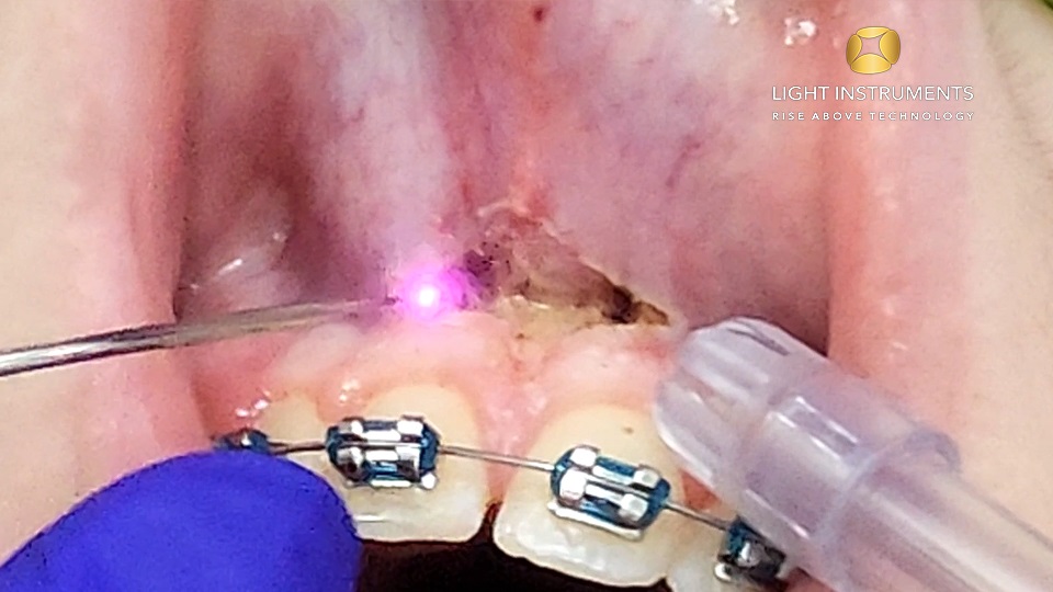 <strong>Frenectomy with the D-Storm™ Diode Laser</strong>