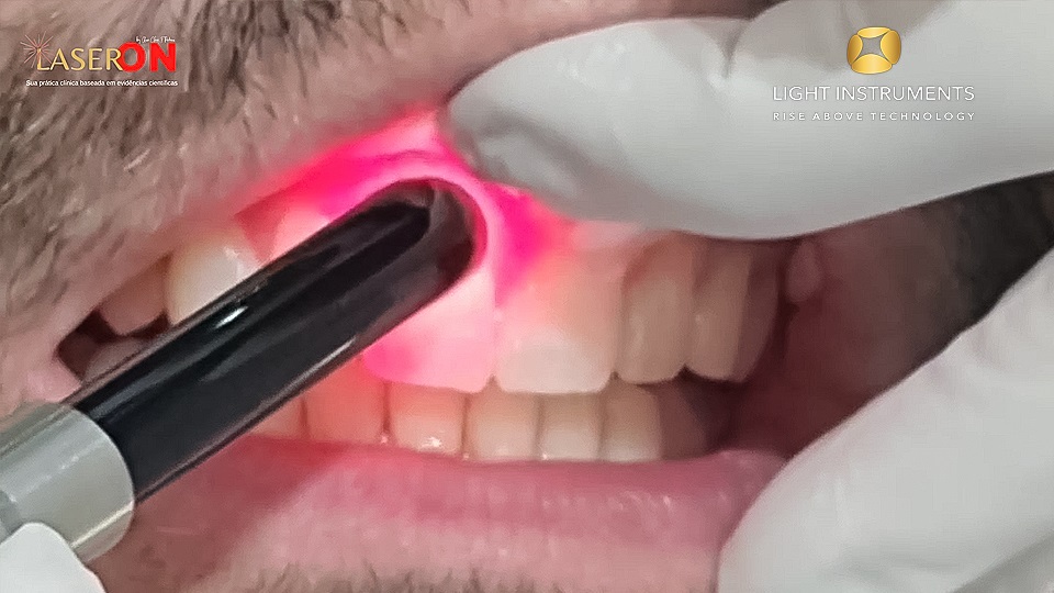 <strong>Gingivectomy with the D-Storm™ Diode Laser</strong>