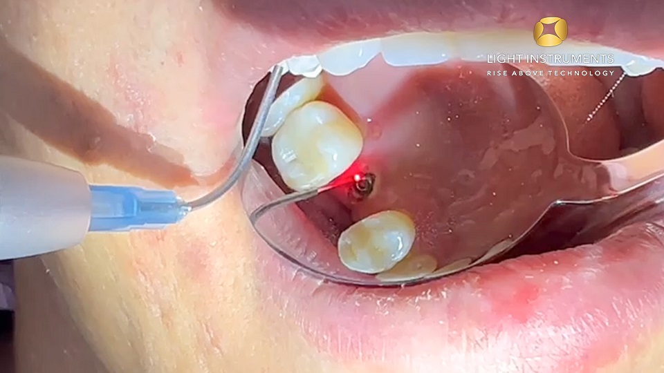 <strong>Implant second stage surgery with the D-Storm™ Diode Laser</strong>