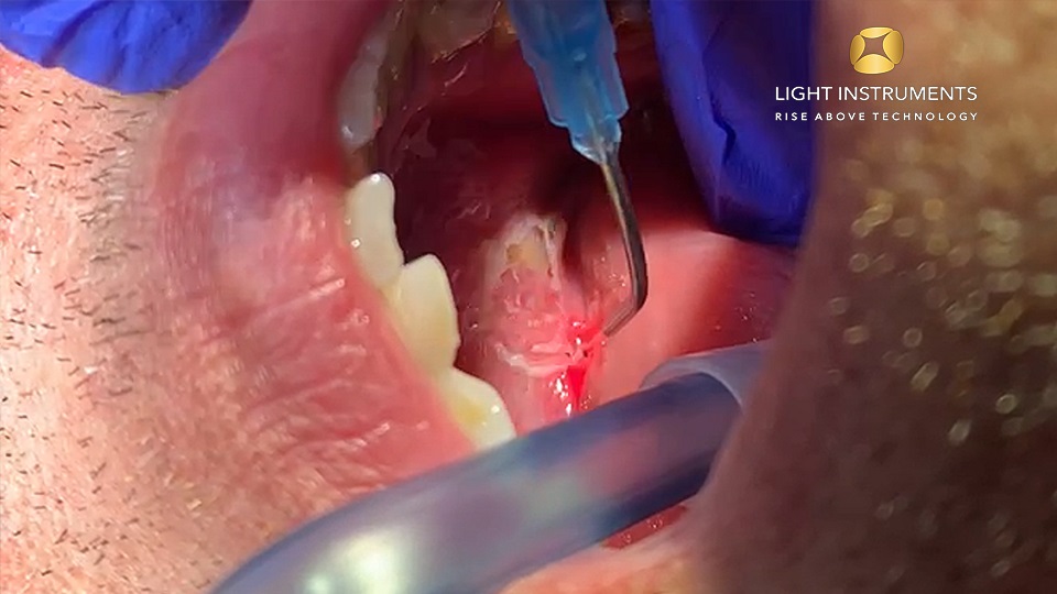 <strong>Leukoplakia removal with the D-Storm™ Diode Laser</strong>