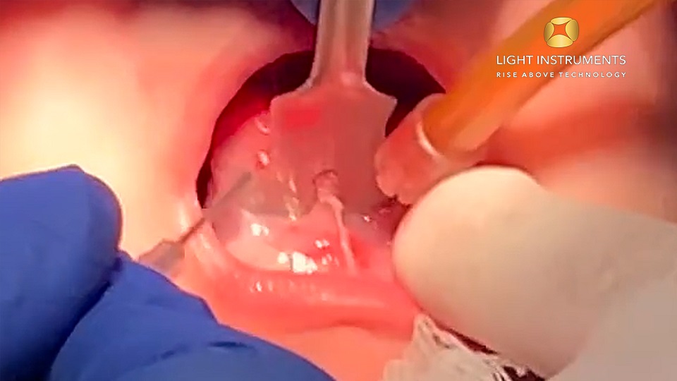 <strong>Lingual frenectomy (tongue-tie) procedure on 3 month old baby with the D-Storm™ Diode Laser</strong>