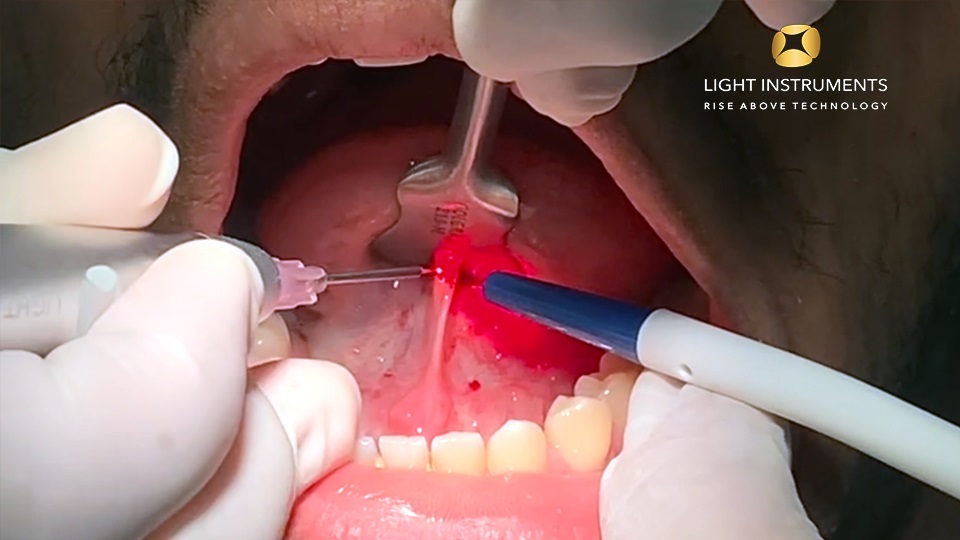 <strong>Lingual frenectomy with the D-Storm™ Diode Laser</strong>