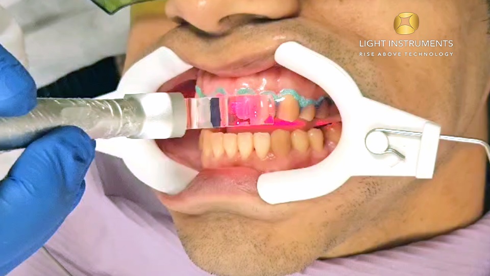 <strong>Whitening with the D-Storm™ Diode Laser</strong>