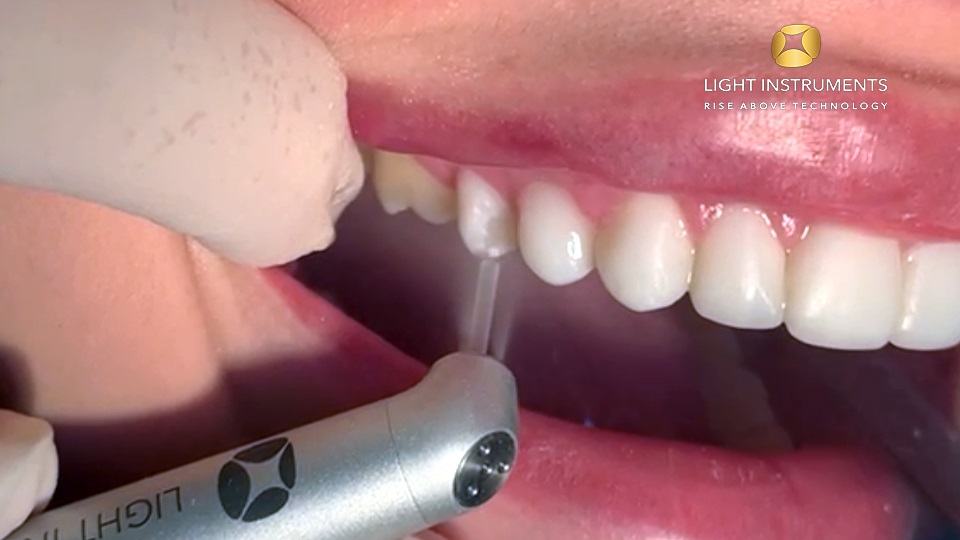 <strong>Composite veneer removal with LiteTouch™ Er:YAG laser</strong>