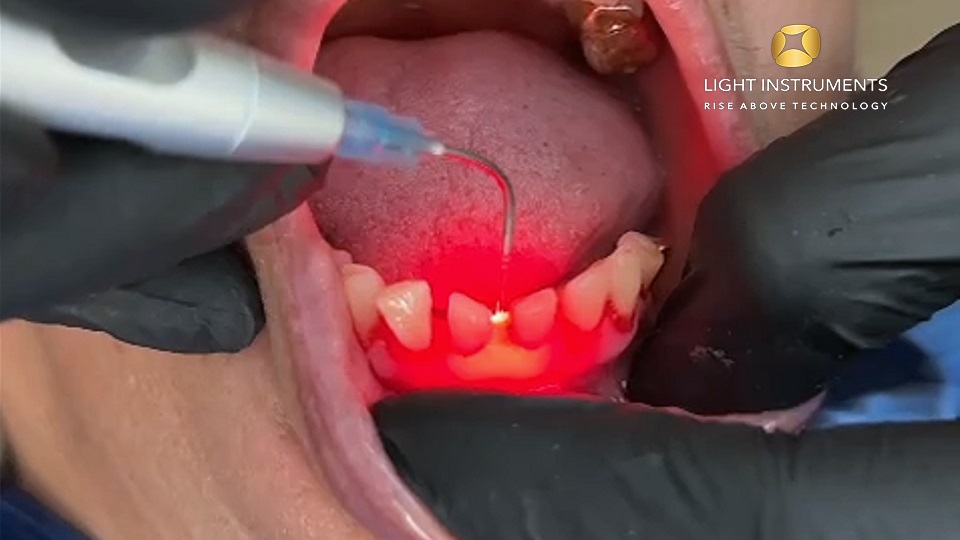 <strong>Disinfection of the periodontal pocket with the D-Storm™ Diode Laser</strong>