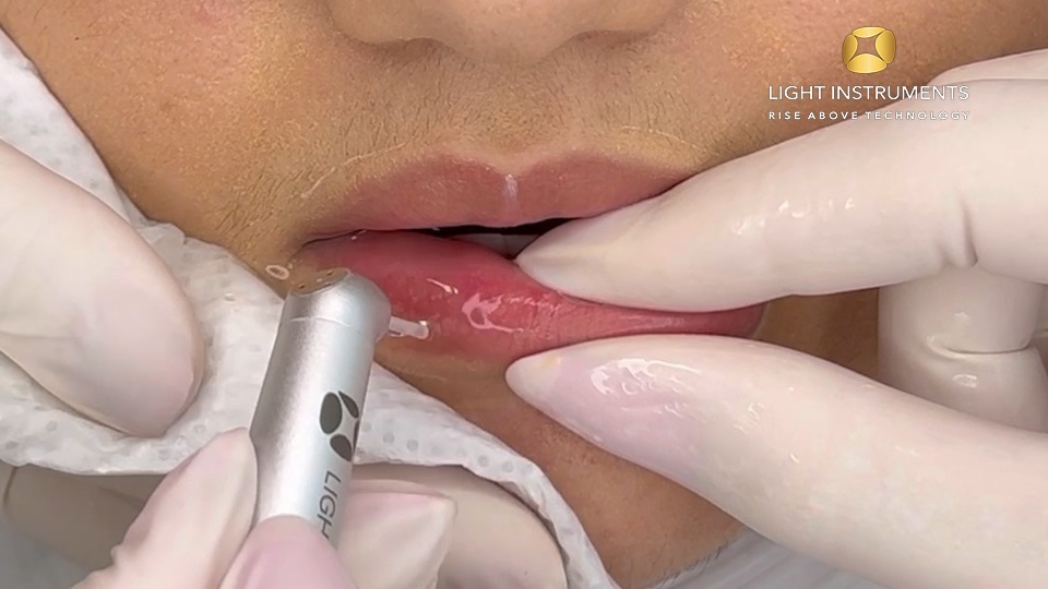 <strong>Lip hydration, nasolabial folds and perioral lines with LiteTouch™ Er:YAG laser</strong>