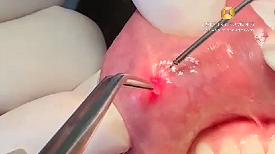 <strong>Mucocele Scar Removal with the D-Storm™ Diode Laser</strong>