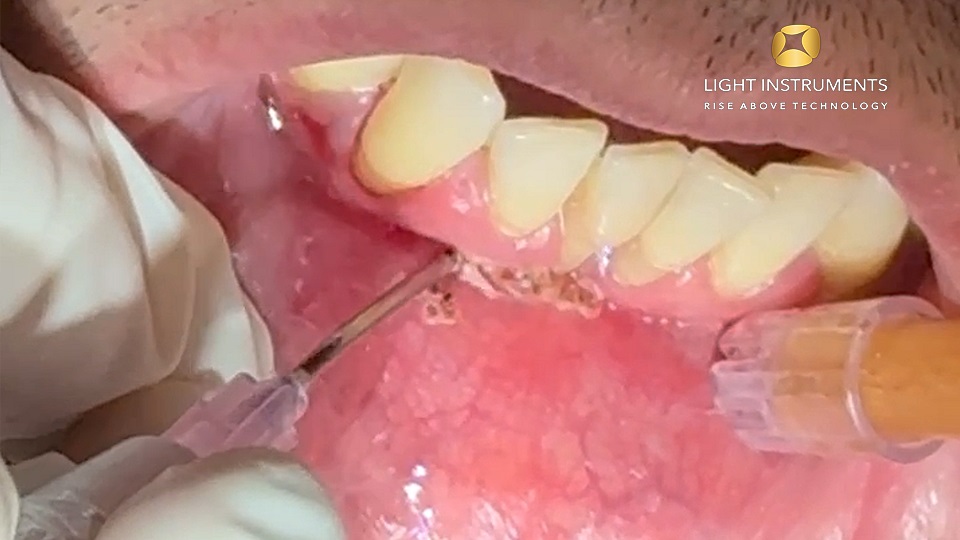 <strong>Frenectomy with the D-Storm™ Diode Laser</strong>