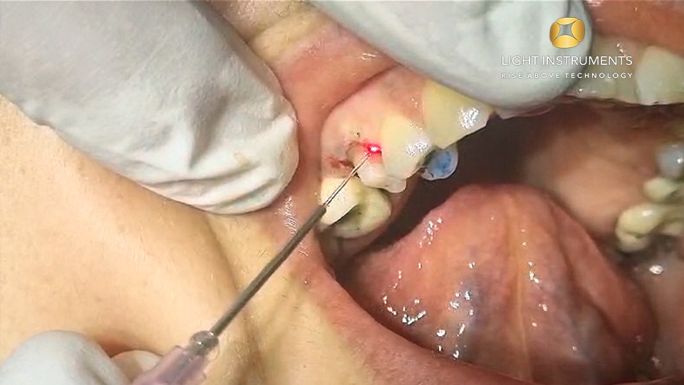 <strong>Gingivectomy with the D-Storm™ Diode Laser</strong>