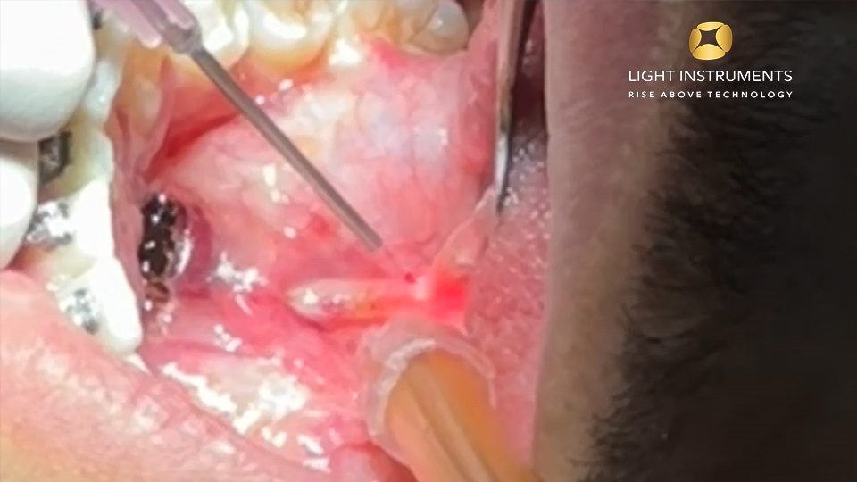 <strong>Lingual frenectomy pocket with the D-Storm™ Diode Laser</strong>