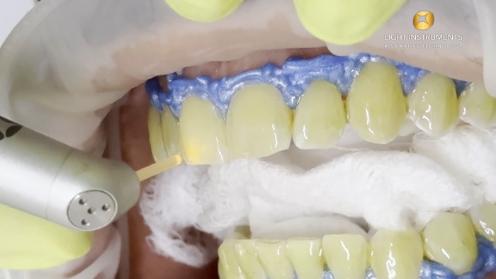 <strong>Teeth whitening with LiteTouch™ Er:YAG laser</strong>