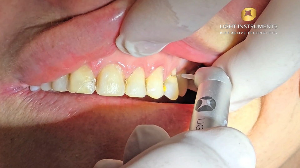 <strong>Class IV removal of composite with LiteTouch™ Er:YAG laser </strong>