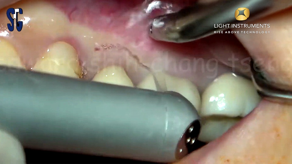 <strong> Laser assisted apicoectomy and ARP with LiteTouch™ Er:YAG laser</strong>