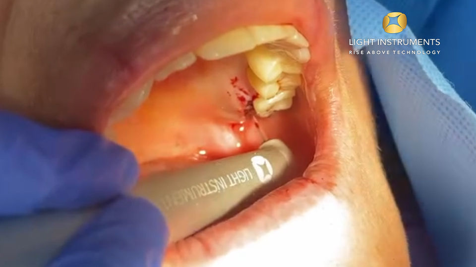 <strong>Hemostasis with LiteTouch™ Er:YAG laser</strong>