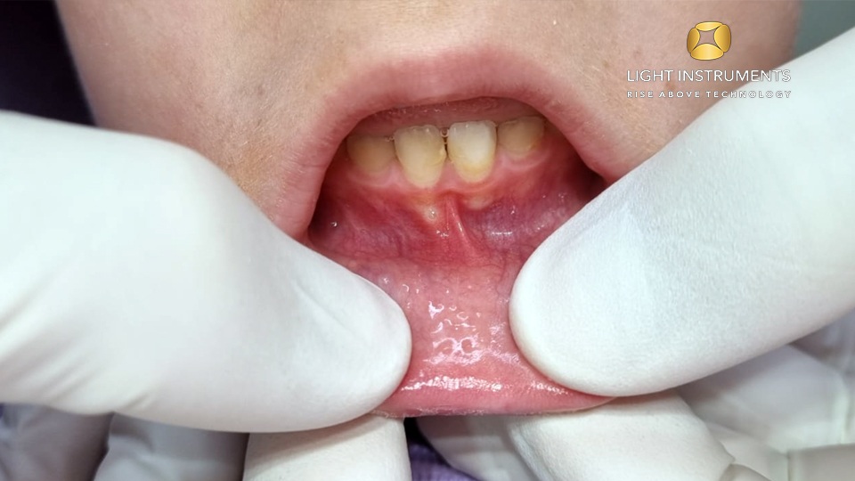 <strong>Aphthous ulcer treatment with the D-Storm™ Diode Laser</strong>