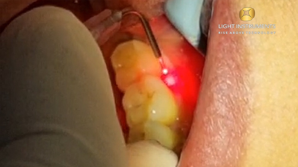 <strong>Caries exposure gingivectomywith the D-Storm™ Diode Laser</strong>