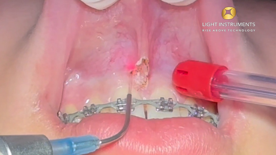 <strong>Frenectomy with the D-Storm™ Diode Laser</strong>