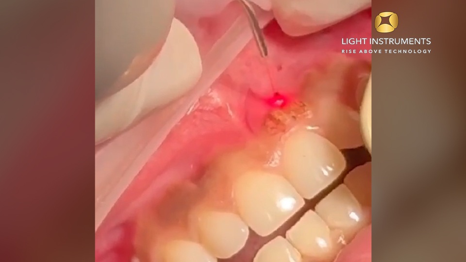 <strong>Gingival hyperpigmentation removalwith the D-Storm™ Diode Laser</strong>
