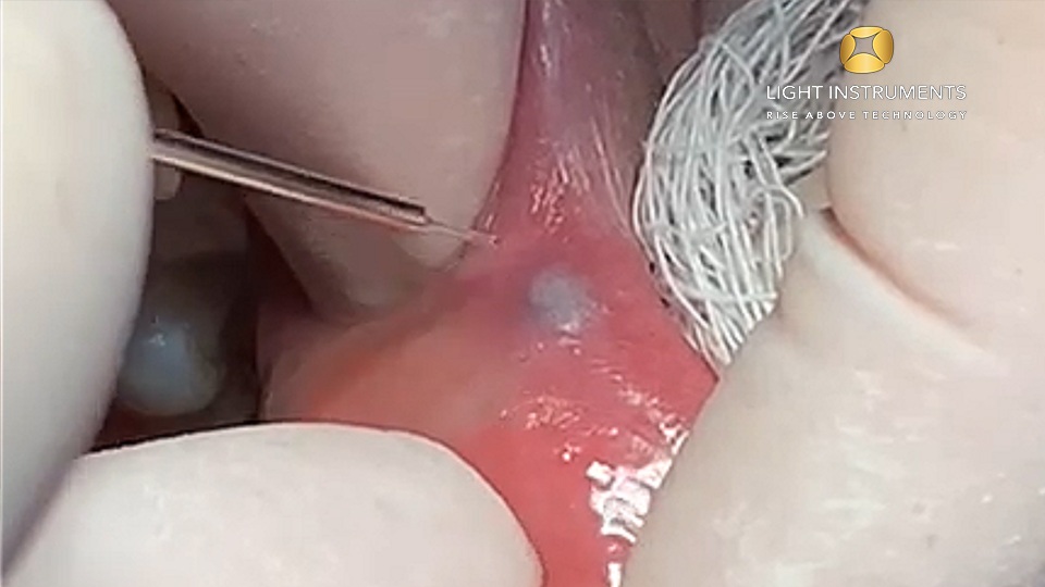 <strong>Hemangioma Treatment with the D-Storm™ Diode Laser</strong>