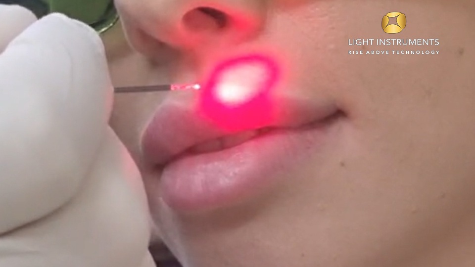 <strong>Herpes Treatment with the D-Storm™ Diode Laser</strong>