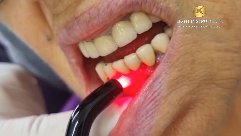 <strong>Laser Bacterial Reduction with the D-Storm™ Diode Laser</strong>