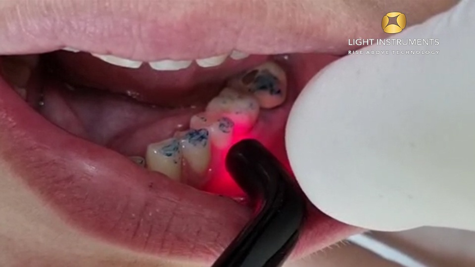 <strong>Photobiomodulation with the D-Storm™ Diode Laser</strong>