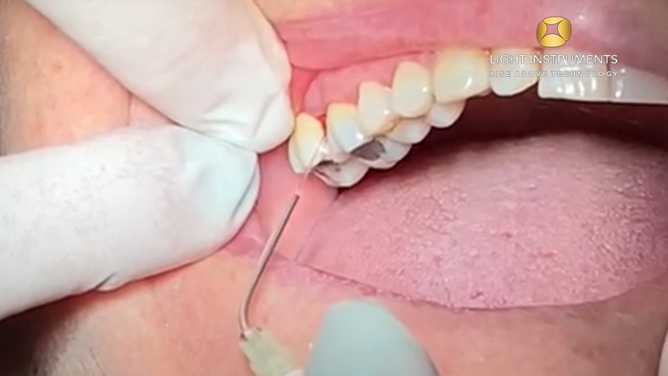 <strong>Pocket disinfection with the D-Storm™ Diode Laser</strong>