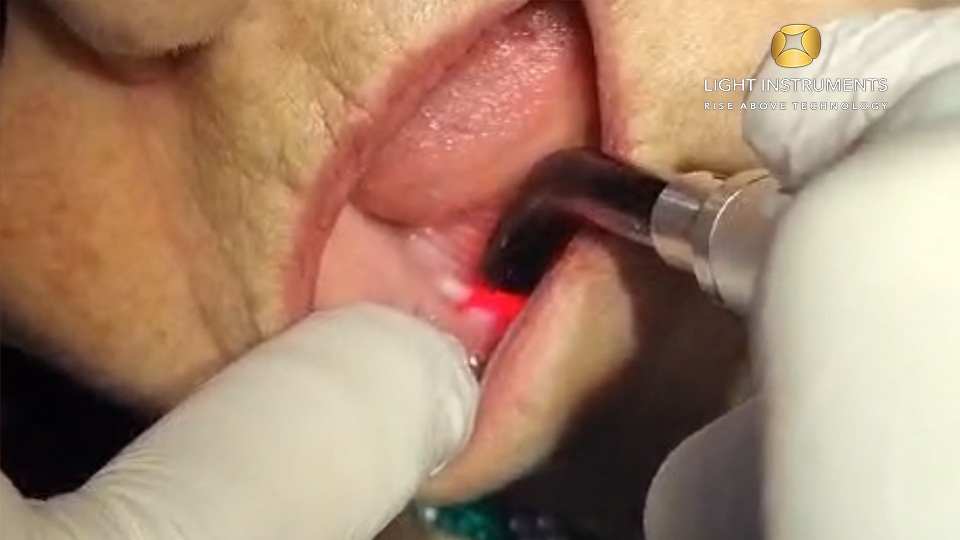 <strong>Prosthetic-Induced Lesion Photobiomodulation with the D-Storm™ Diode Laser</strong>
