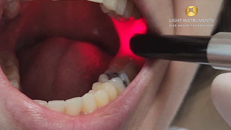 <strong>TMJ Treatment with the D-Storm™ Diode Laser</strong>