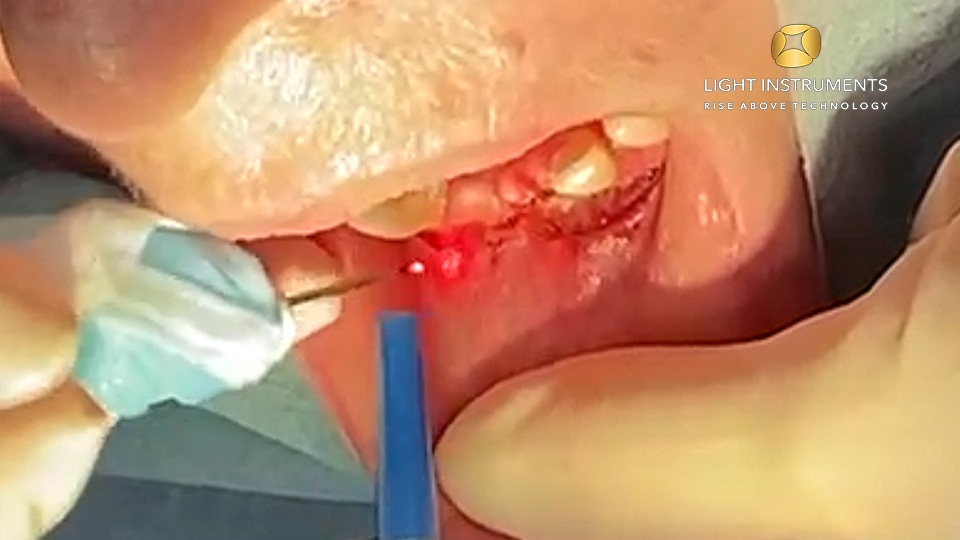 <strong>Vestibular deepening to improve periodontal pre-prosthetic with the D-Storm™ Diode Laser</strong>